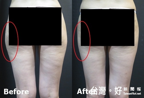 連難瘦的大腿外側，線條都變得柔順許多了呢， 但醫師提醒療程效果會因個人體質而有所差異。（圖／杏立博全診所 提供）