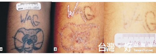 皮秒雷射在刺青、班點、胎記上,均可獲得高滿意度治療效果,但醫師提醒療程效果會因個人體質而有所差異。(圖/悠美診所提供)