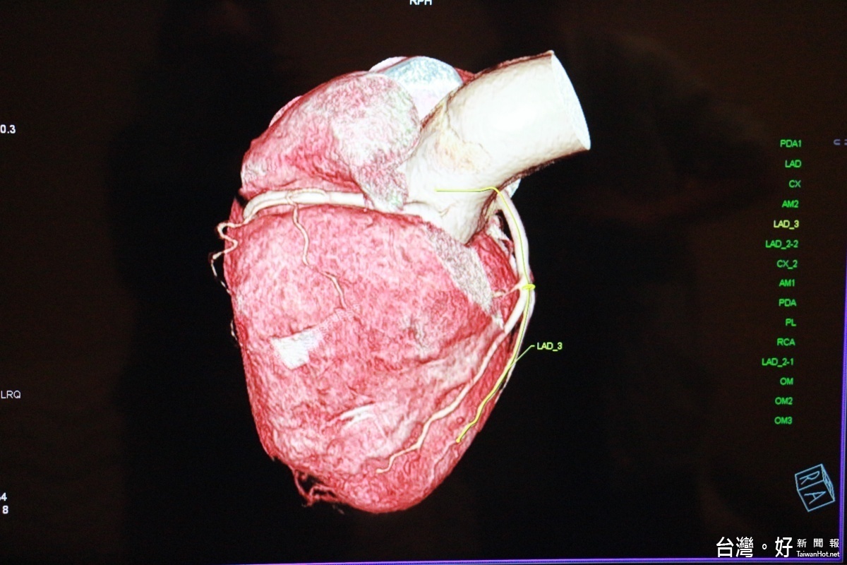 384切電腦斷層掃描之3D畫面可精準的檢查出意想不到的病灶。 