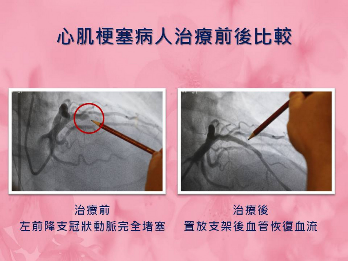 心肌梗塞病人治療前後比較。