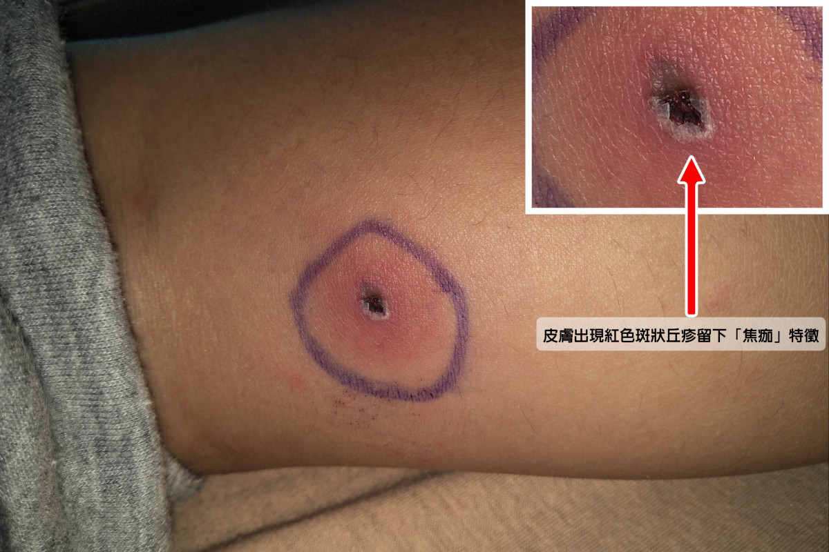 皮膚出現紅色斑狀丘疹留下「焦痂」特徵。