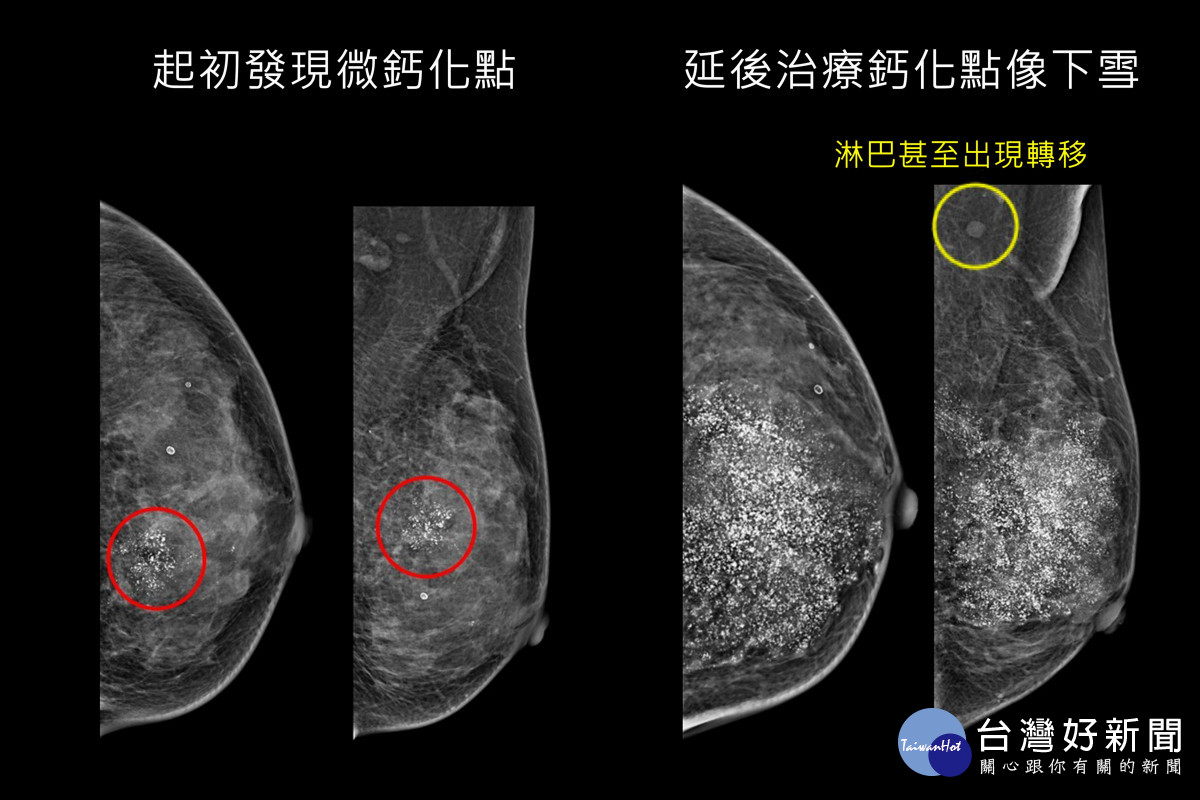 婦人接受乳房攝影篩檢發現微鈣化點，再切片確認罹患早期乳癌（左圖 ），延後治療再檢查，鈣化點如下雪並已出現淋巴轉移（右圖 ）。