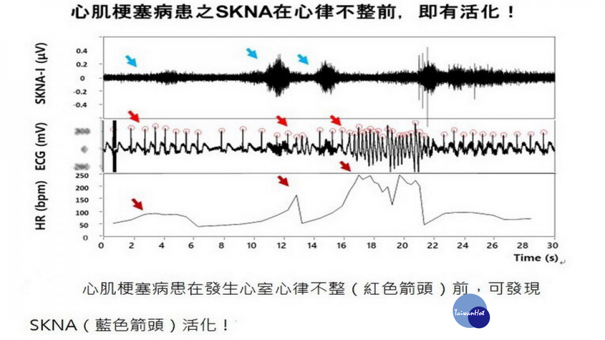 ▲心肌梗塞病人之SKNA數值與發生心室心律不整有顯著的相關性。