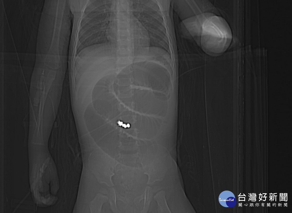 男嬰的X光檢查照片。