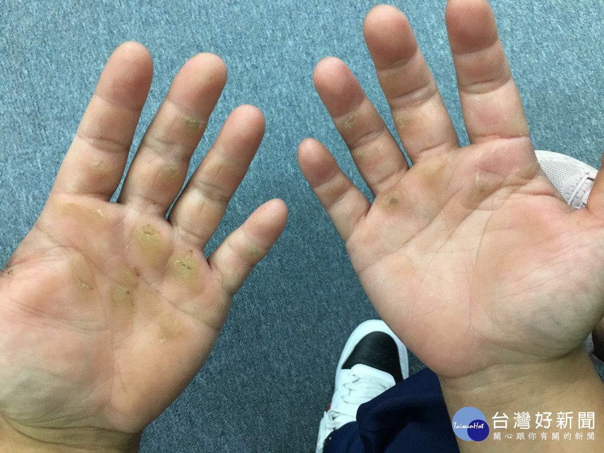 為國爭光付出的代價每位選手滿手的繭。（記者扶小萍攝）