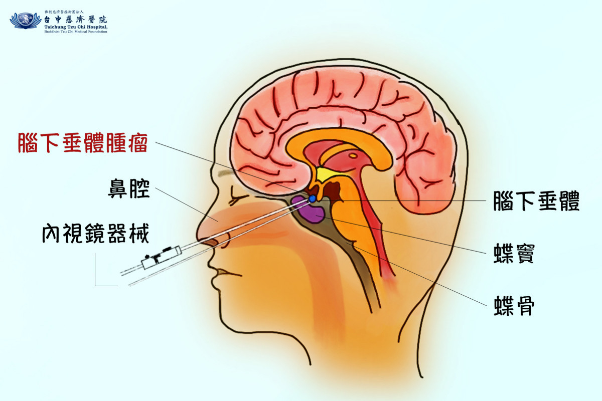 6旬婦左眼籠罩黑影看不清　腦下垂體瘤作祟 台灣好新聞 第2張