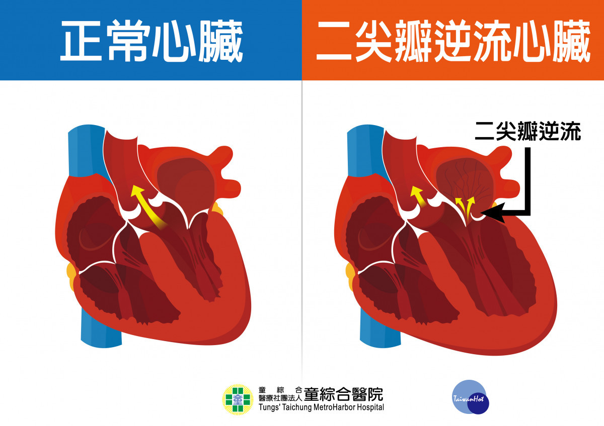 正常心臟與二尖瓣逆流心臟對比圖。
