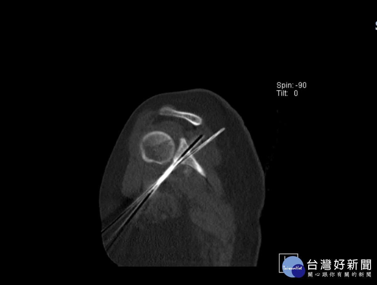 複合式手術室使用電腦斷層可直接在手術中定位進行精準復位手術。