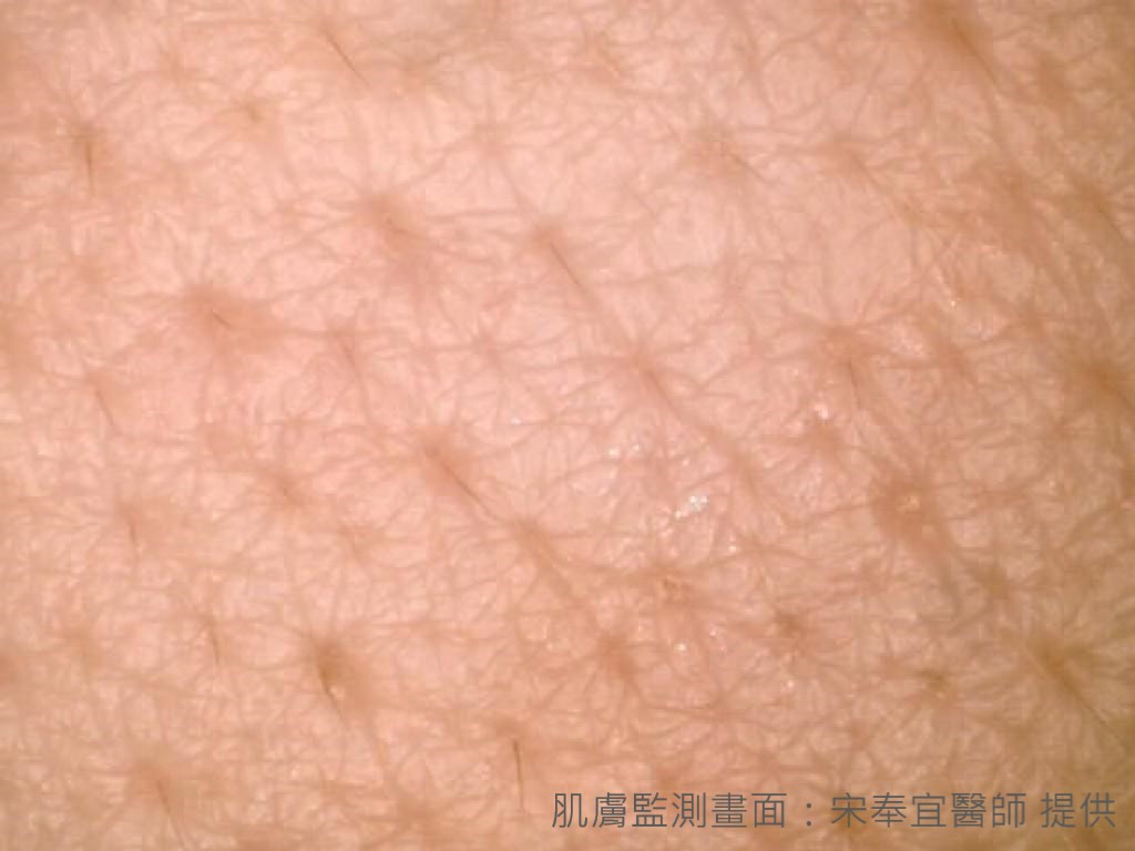 肌膚監測》青春痘、成年痘　傻傻分不清楚