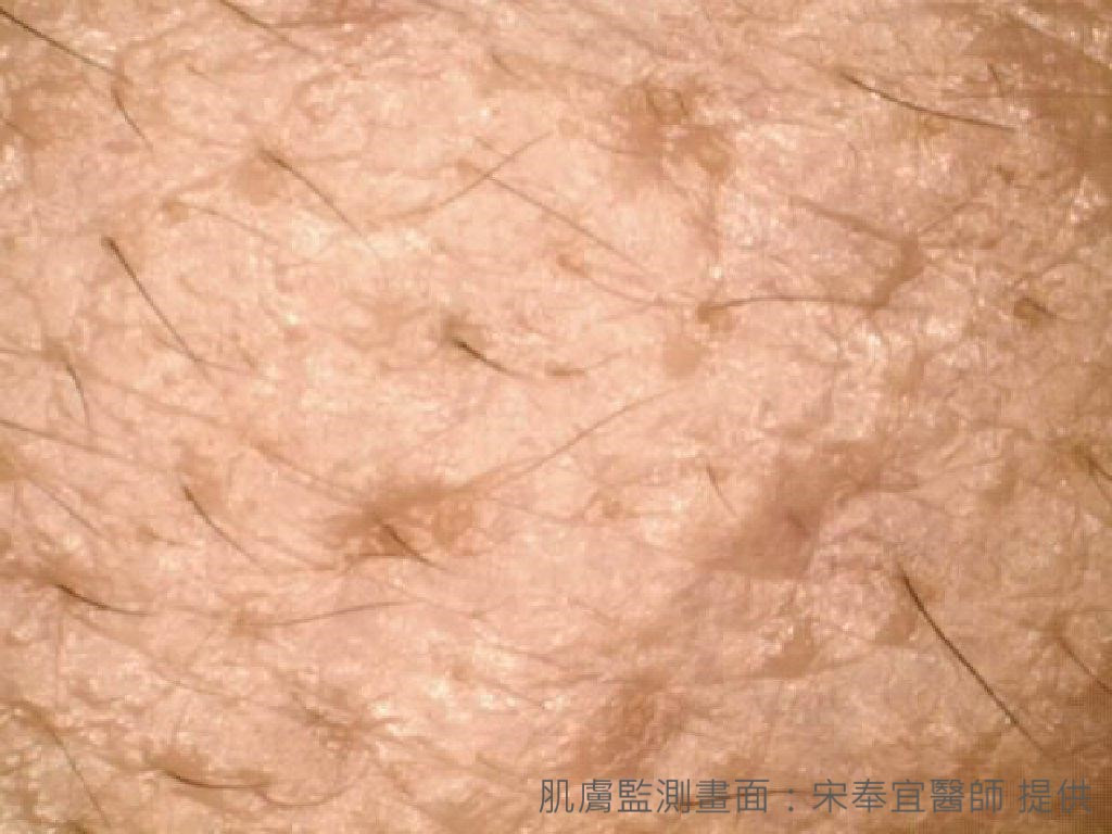 肌膚監測》青春痘、成年痘　傻傻分不清楚