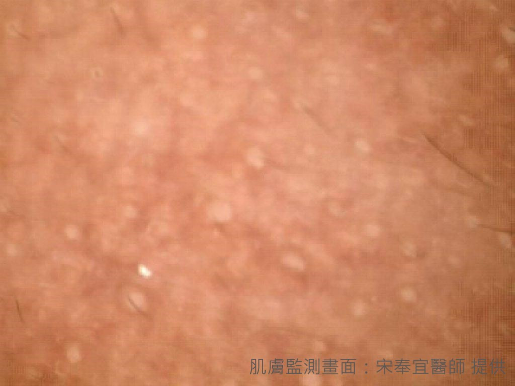 肌膚監測》青春痘、成年痘　傻傻分不清楚