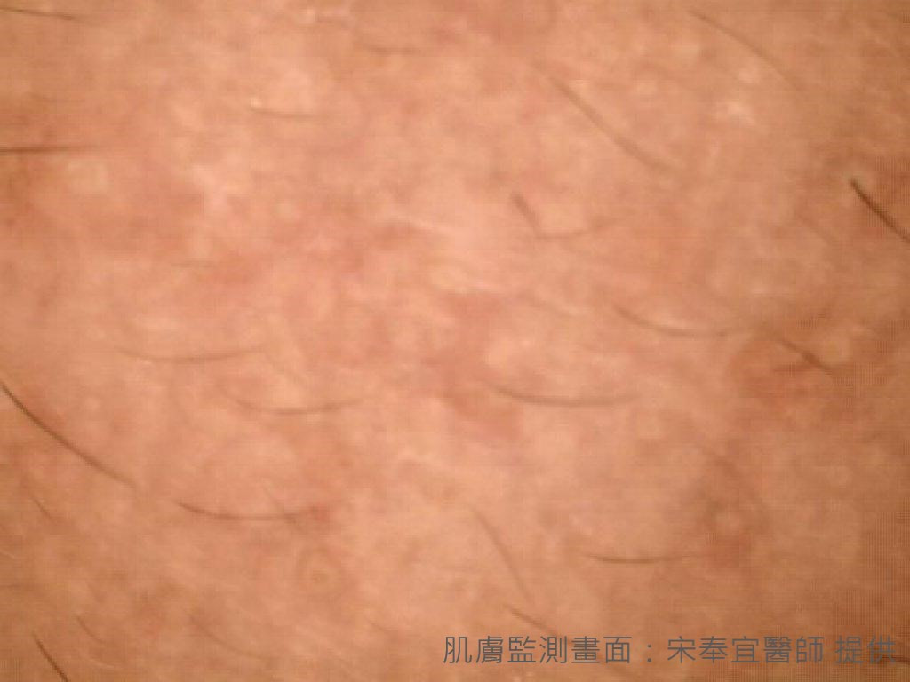 肌膚監測》青春痘、成年痘　傻傻分不清楚