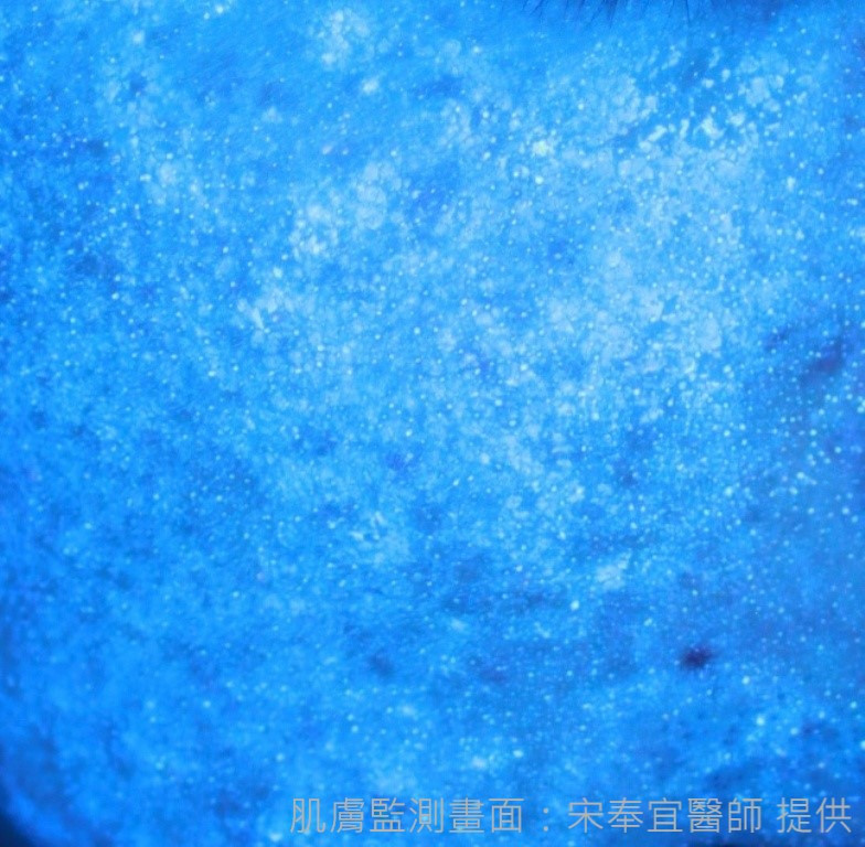 肌膚監測》青春痘、成年痘　傻傻分不清楚