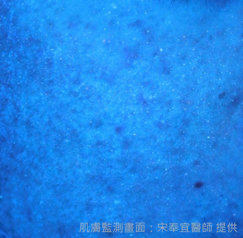 肌膚監測》青春痘、成年痘　傻傻分不清楚
