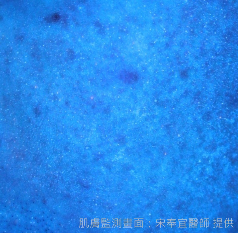 肌膚監測》青春痘、成年痘　傻傻分不清楚