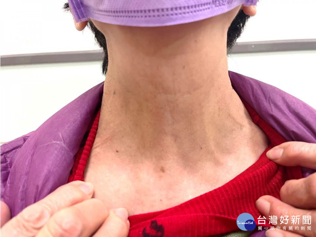 嘉義基督教醫院以達文西手術系統,為患者進行甲狀腺切除手術,不僅腫塊消除,聲音不會沙啞,且頸部不留痕跡/嘉基提供