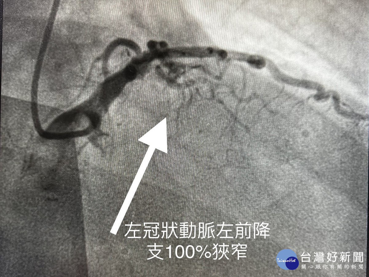 左冠狀動脈左前降支100%阻塞