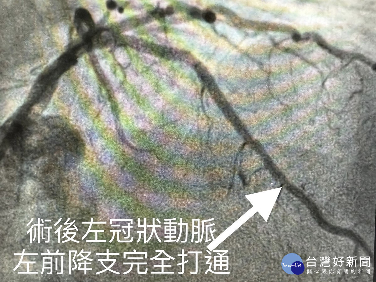 左冠狀動脈左前降支完全打通