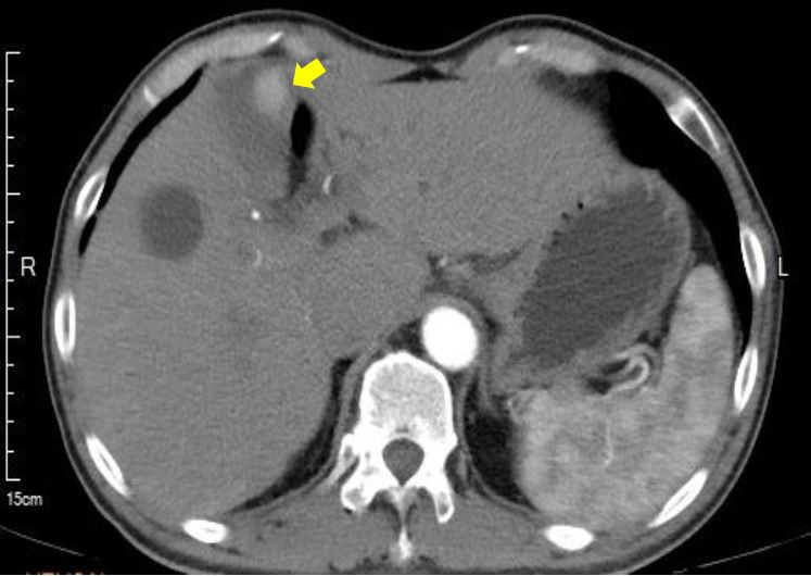 圖說：檢查影像顯示，病人肝臟腫瘤位置因靠近腸道(如箭頭所示)，故不適合做局部治療。