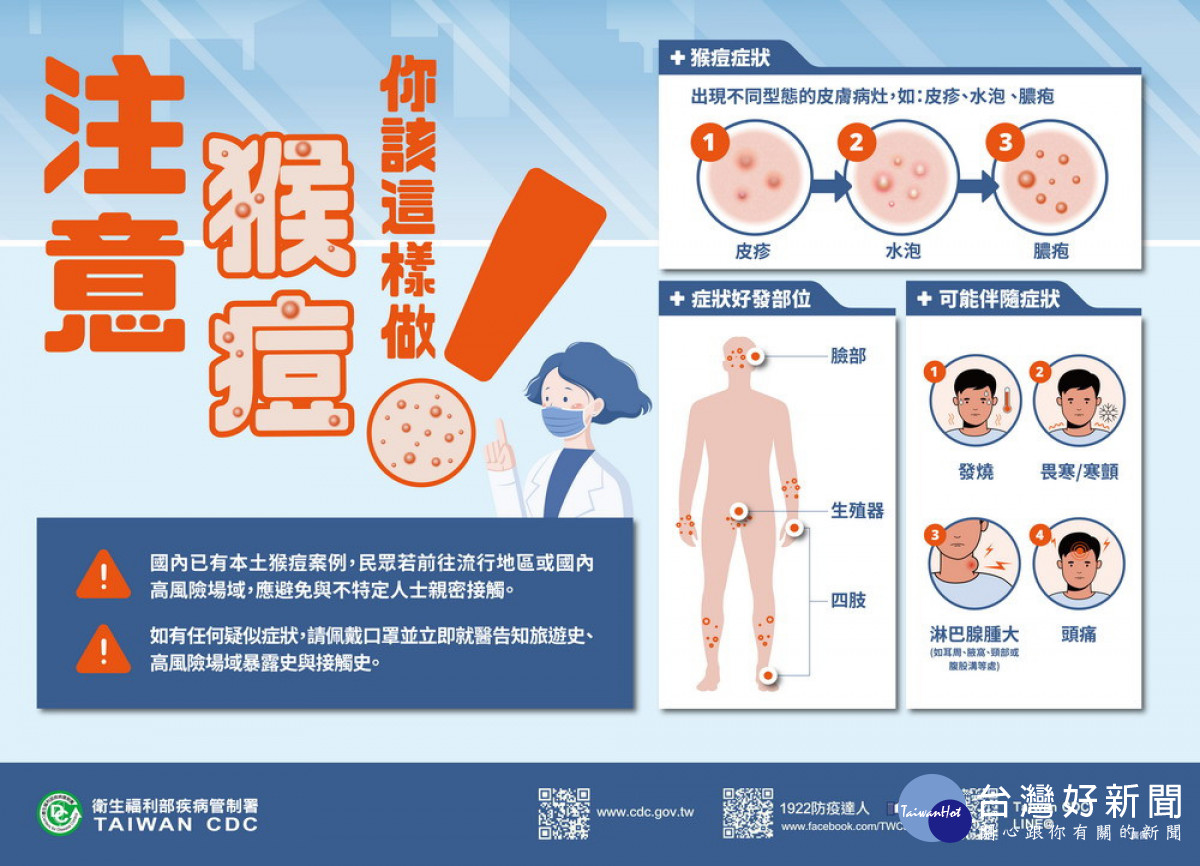 高市發現第2例猴痘病例　有疑似症狀請應儘速就醫