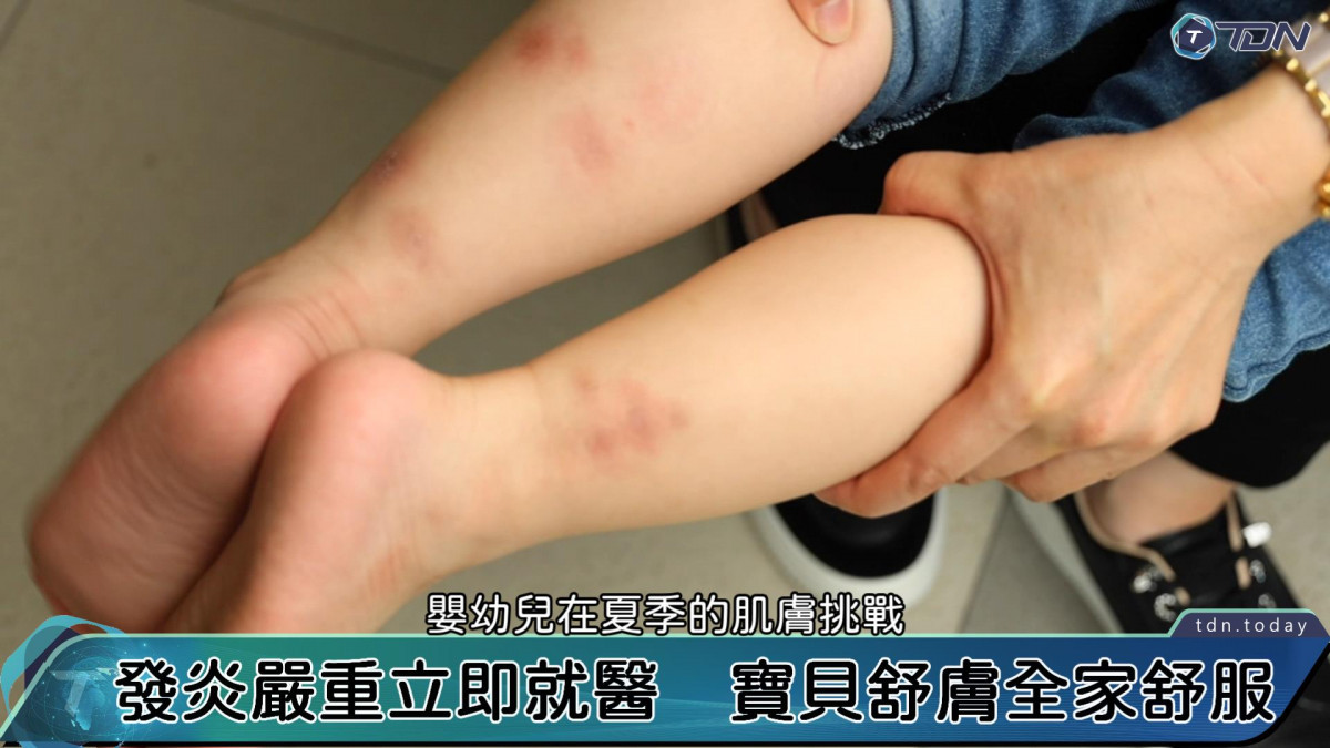 影／寶寶肌膚夏季大挑戰　皮膚科醫：四大步驟讓寶寶舒適一夏