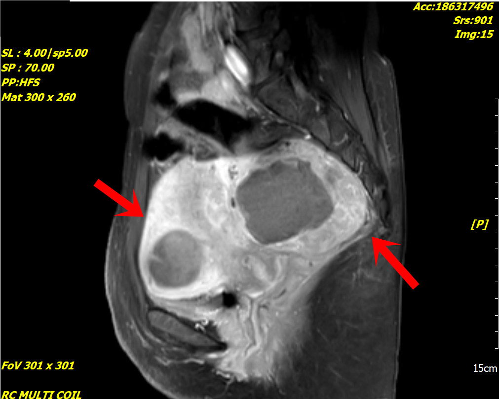 術後MRI (紅色箭頭是兩顆肌瘤位置, 灰黑色圓形狀是凝固性消融後組織壞死的肌瘤,白色部位則是未壞死暫存的肌瘤組織, 肌瘤組織持續壞死中)。