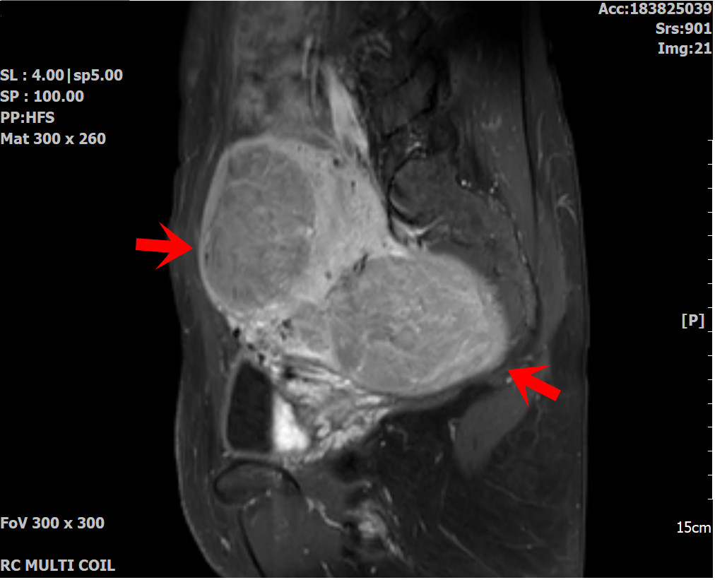 術前MRI (紅色箭頭是兩顆肌瘤位置)。