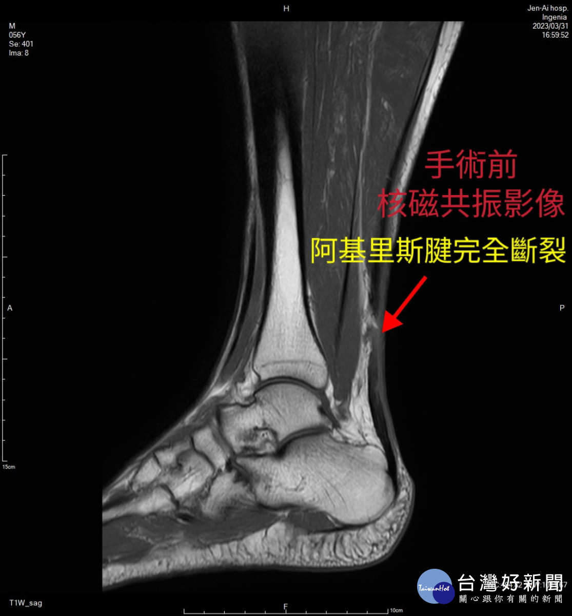 阿基里斯腱即腳筋。林重鎣攝<br /><br />
<br /><br />
