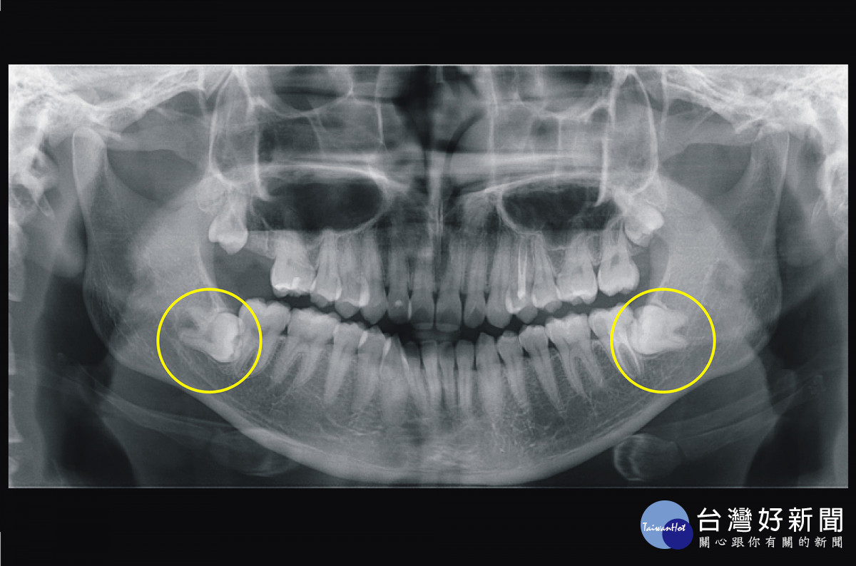 環口影像可見雙側阻生智齒牙根皆緊鄰下齒槽神經。圖／彰基醫院提供