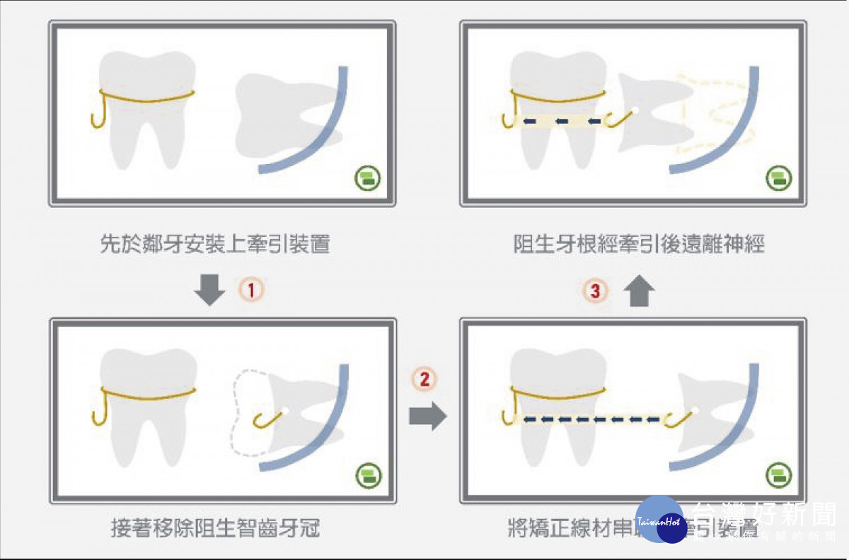 阻生齒牽引術流程圖示說明。圖／彰基醫院提供