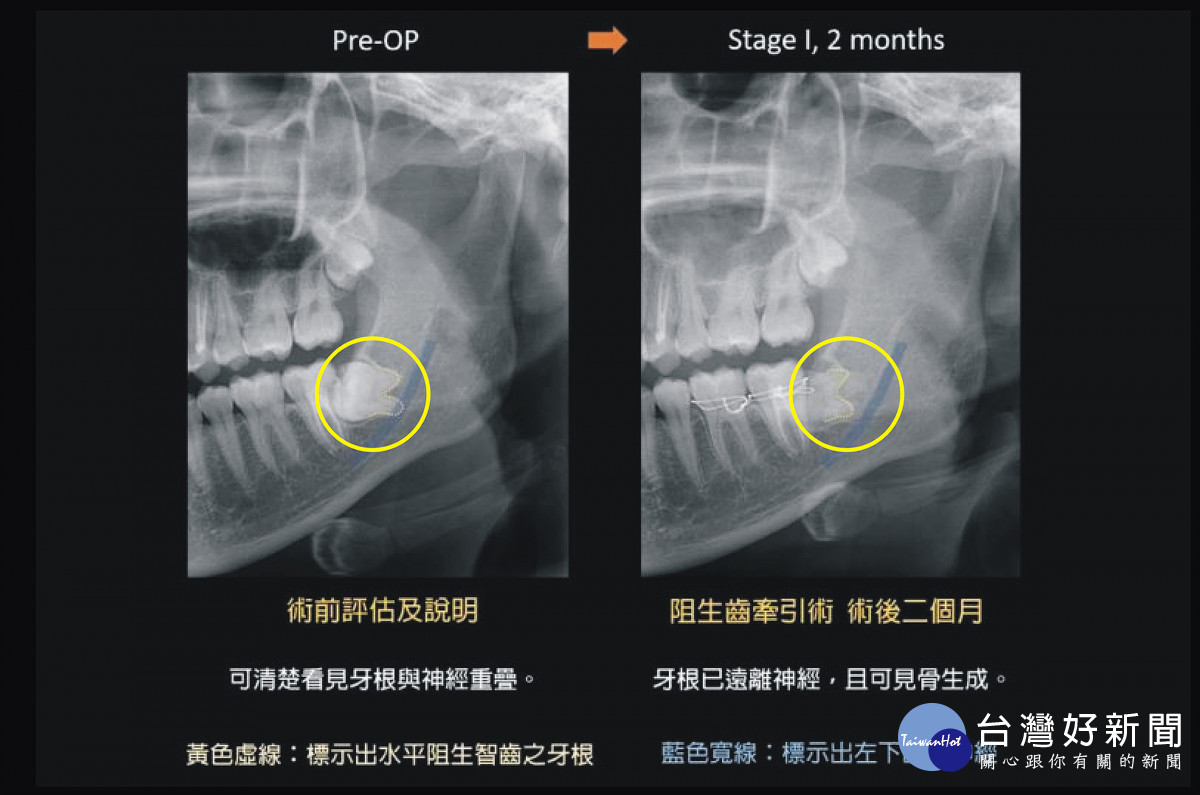 術後（右圖）可見阻生智齒牙根已遠離神經管，且可見牽引生成之骨頭。圖／彰基醫院提供