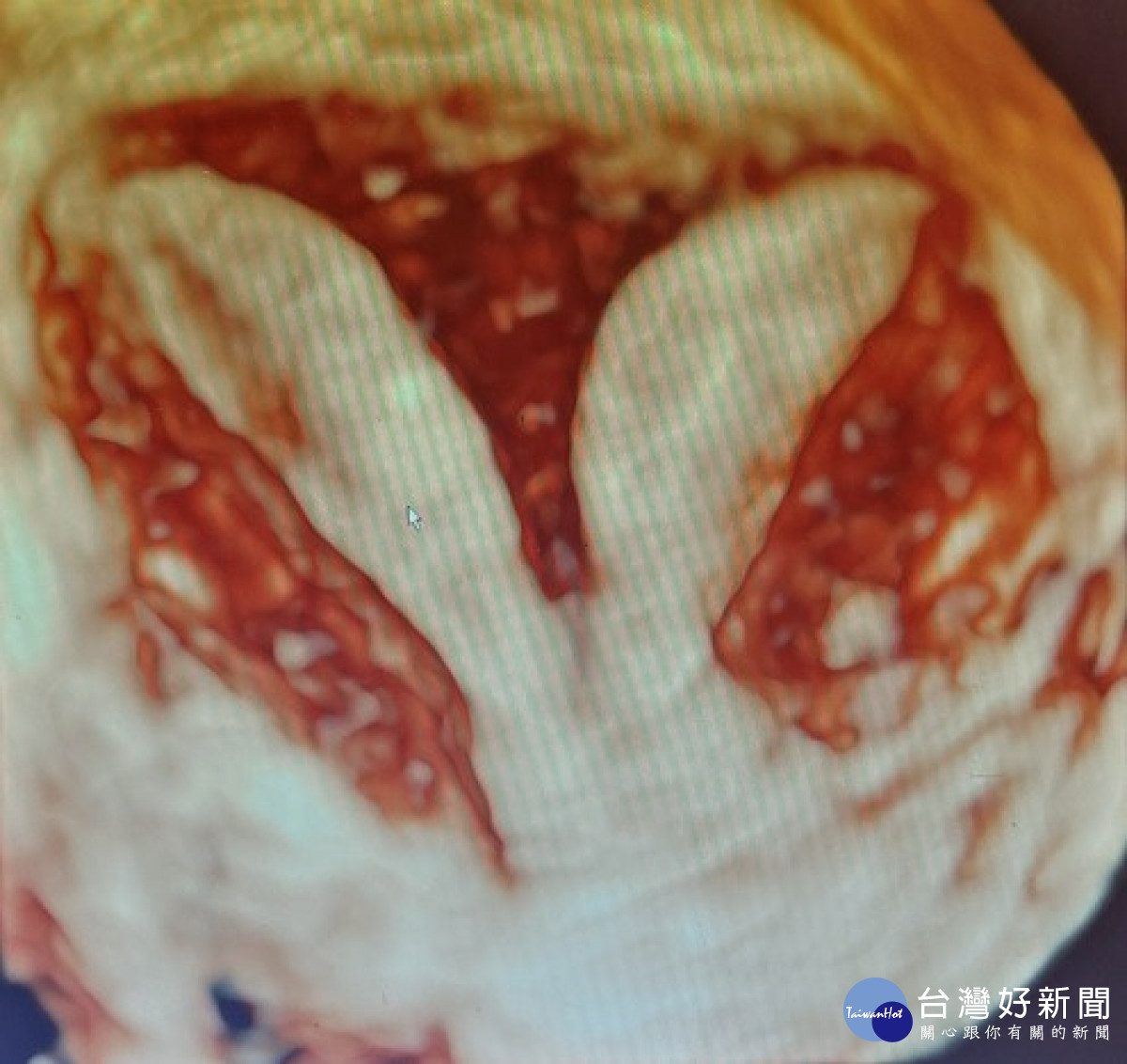 茂盛醫院副院長陳忠義將雙陰道間的中膈肌肉切除使陰道合而為一。茂盛醫院提供