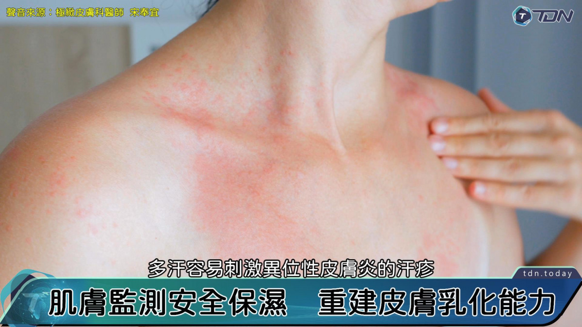 影／夏季異位性皮膚炎高峰！　醫：抗敏防炎撇步報你知