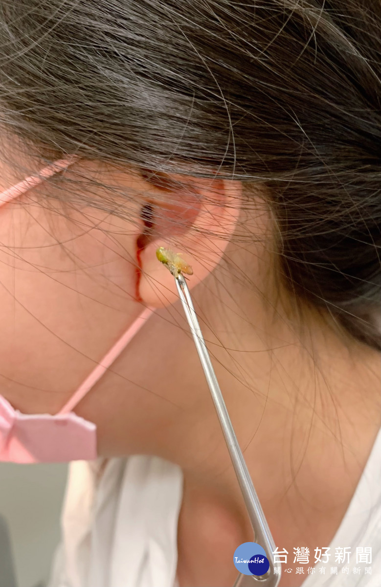 蟋蟀爬進耳朵　應尋求專業醫師協助-指尖健康網