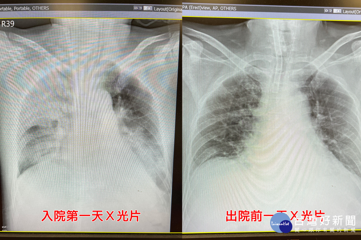 葉先生入院時與出院前的X光片。