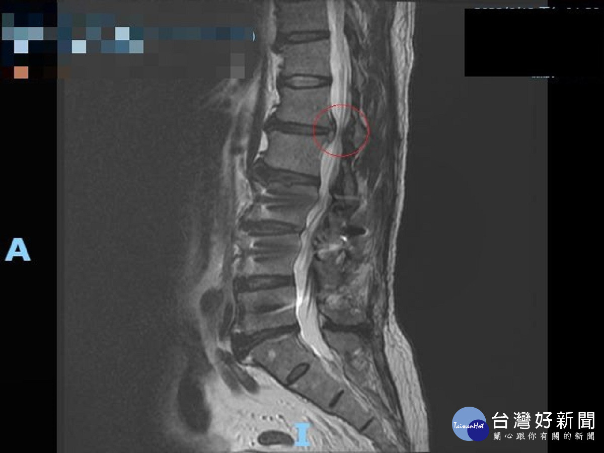 男腹股溝疼痛疑是結石引發　檢查病灶卻是近胸椎的椎間盤突出引發