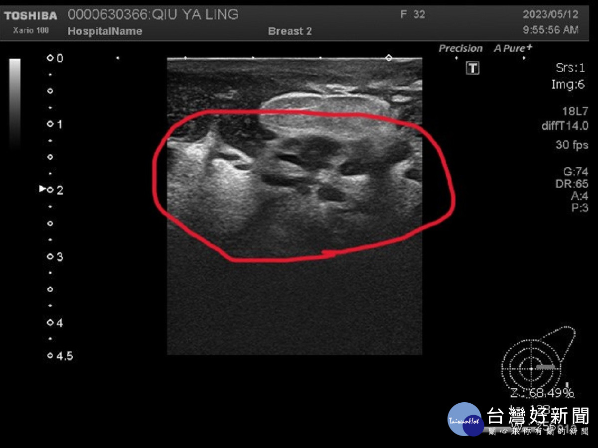 少婦乳房腫痛、潰爛憂心被切除 求助員榮醫師查出竟是罕見結核菌作崇引起