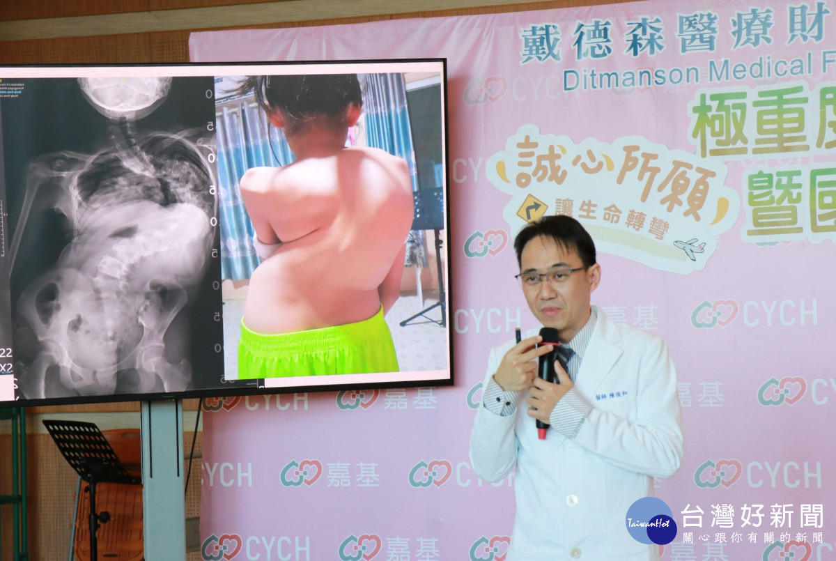 嘉基小兒骨科陳俊和醫師說明誠心脊椎側彎高達極重度的160度／嘉基醫院提供