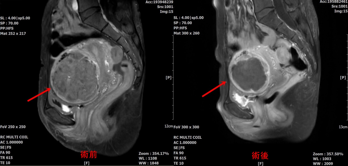 術前術後比較。