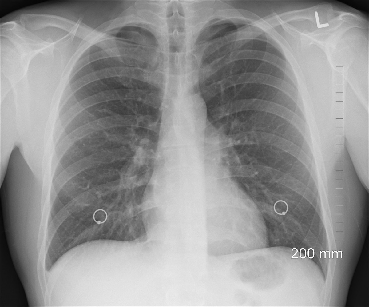 肺部X光片示意圖（圖／資料照片，圖源：Pixabay）