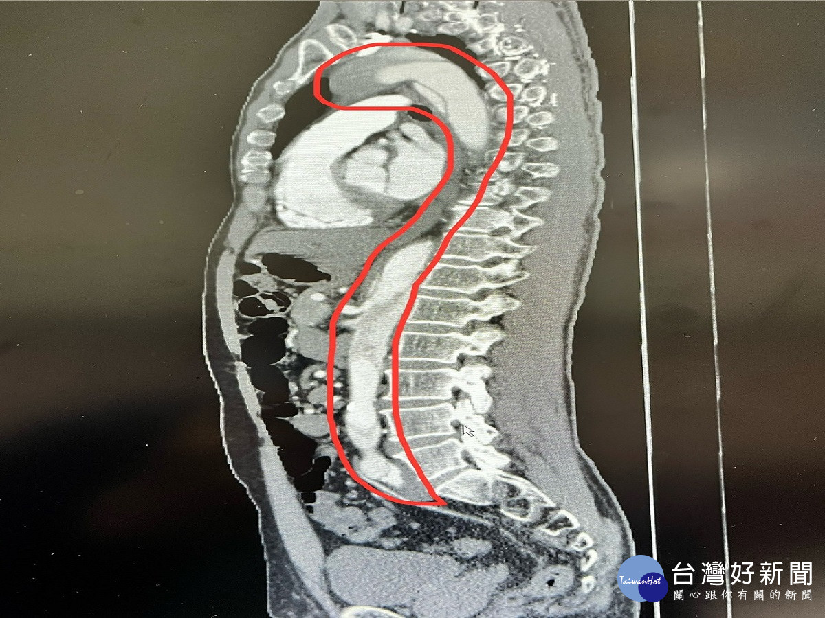 壯男因胸悶吸呼不順診斷主動脈剝離　醫師與時間賽跑鬼門關前救回一命