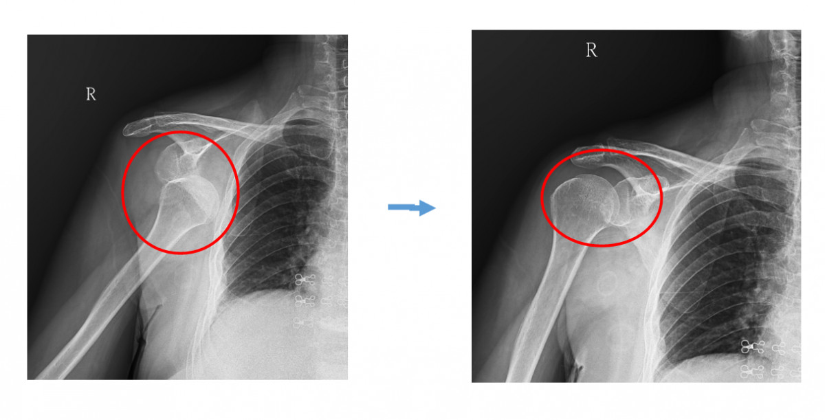 楊大媽右側肩關節脫臼X光片<br />
