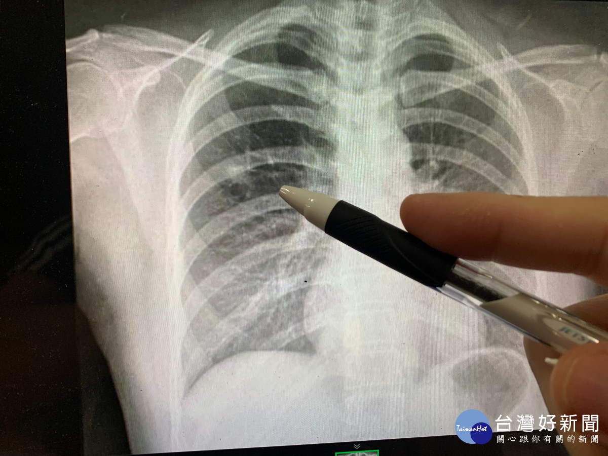 患者右胸有顆早期肺癌