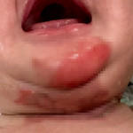 嬰兒因熱水蒸氣不慎潑灑，導致下巴、脖子及肩膀多處燙傷。