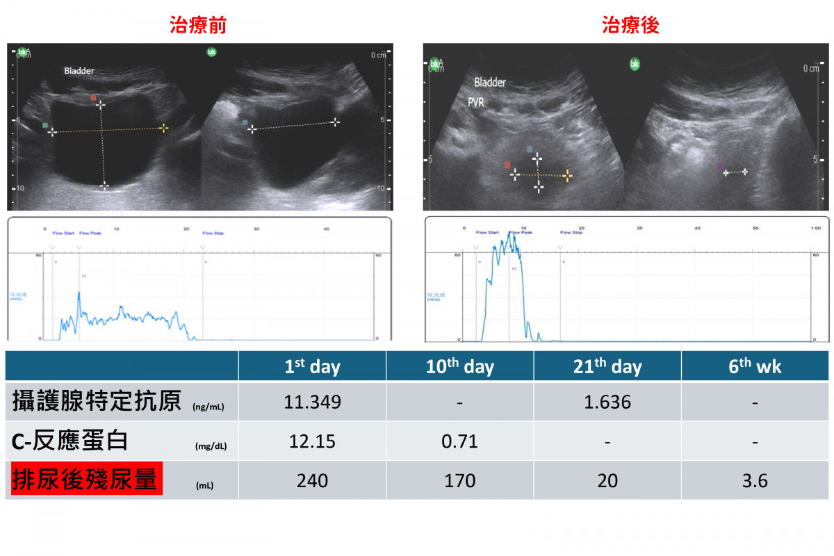 治療後林先生殘尿降至20c.c.以下，排尿順暢、症狀改善，六週追蹤穩定，證實療效明確。圖／彰基提供