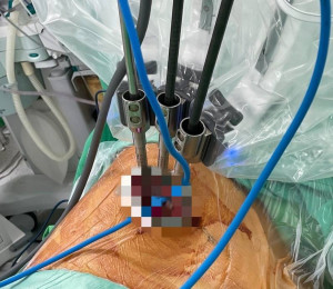 新竹臺大分院蘇柏耕醫師操作達文西輔助單孔胸腔鏡系統。