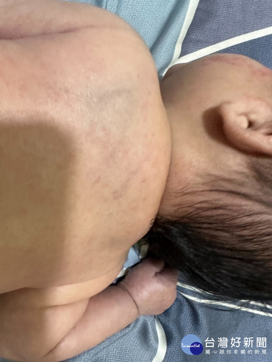家長控訴孩子疑似遭到蕭姓保母不當對待，全身傷痕累累。（圖/臉書「記憶八德」）
