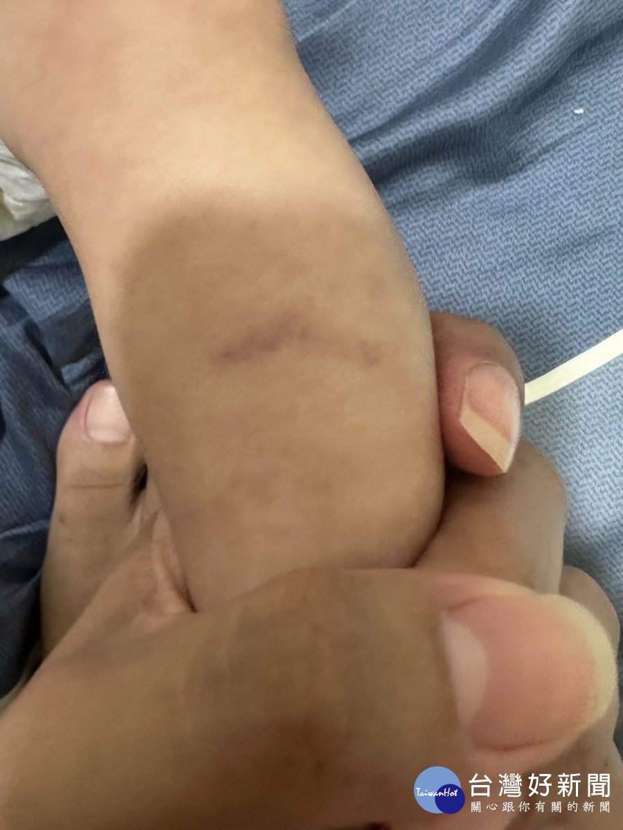 家長控訴孩子疑似遭到蕭姓保母不當對待，全身傷痕累累。（圖/臉書「記憶八德」）