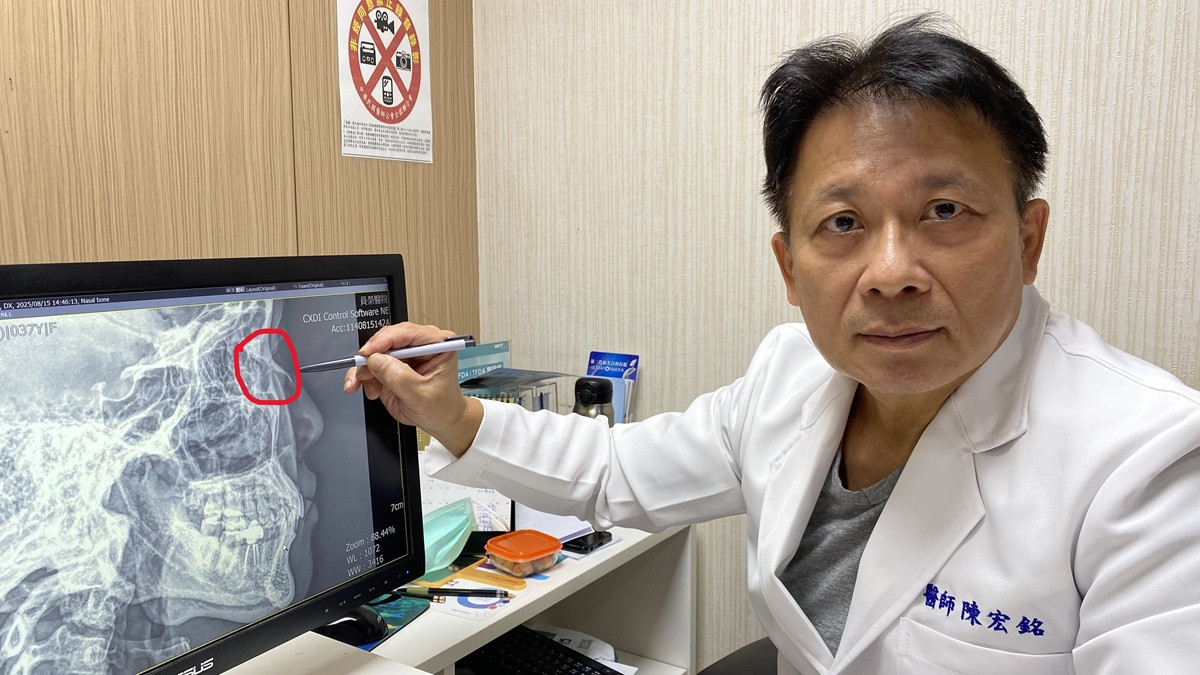 兩歲小孩往媽媽鼻子一撞鼻骨竟斷了  醫師呼籲：顏面受傷患者把握黃金治療期