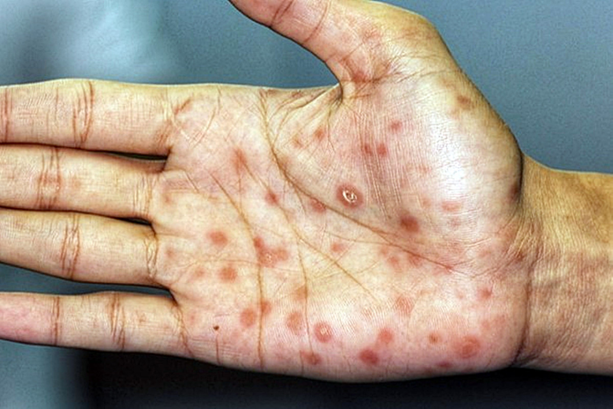 手掌或腳掌出現丘疹是梅毒常見病徵之一